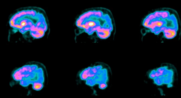 PET scanning af hjernen viser tegn på Alzheimer's