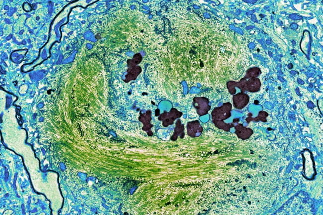 tau-protein i hjernen
